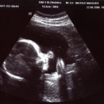 échographie effectuée pendant la grossesse