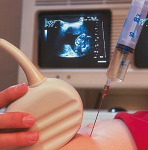 Examens du 2eme trimestre de grossesse : L'amniocentèse