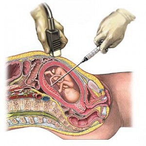 Calendrier des examens du 2ème trimestre de grossesse : La cordocentèse