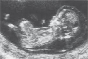 Examens du premier trimestre de grossesse: l'échographie de la clarté nucale.