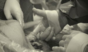 Un bébé saisit le doigt d'un chirurgien pendant une césarienne